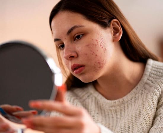 Acne