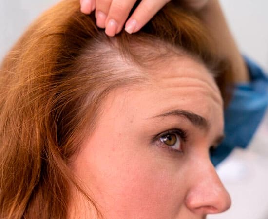 Queda de cabelo e alopecias