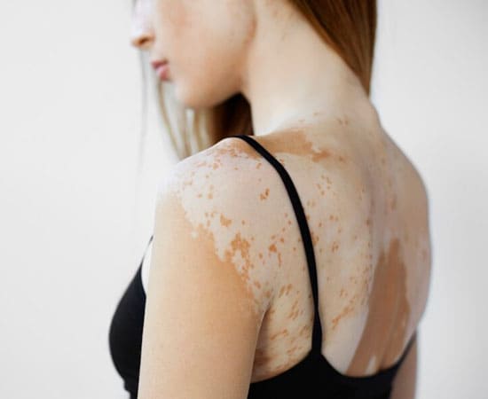 Vitiligo